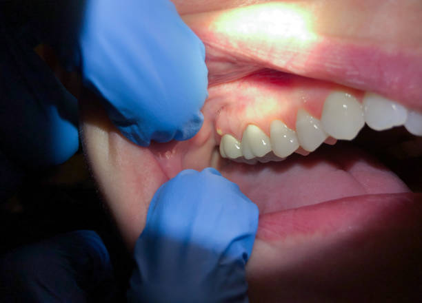 Best Emergency Treatment for Dental Infections or Abscesses in Orange City, IA