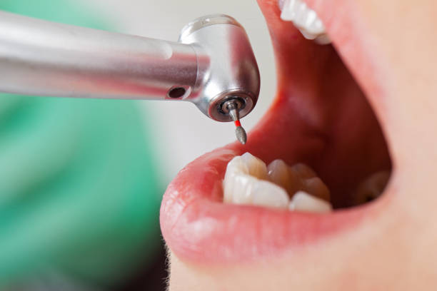 Best Urgent Care for Lost Fillings or Crowns in Orange City, IA